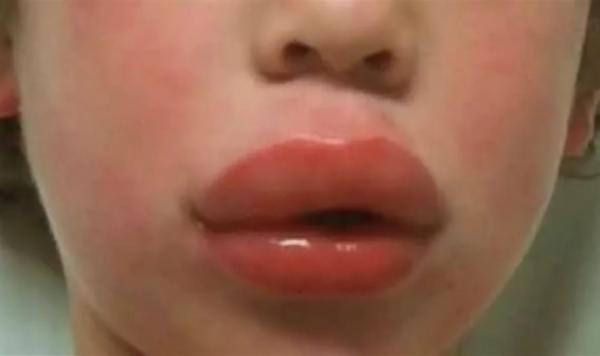 Аллергический отек губ код мкб thumbnail