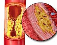 Атеросклероз брюшного отдела аорты код мкб thumbnail
