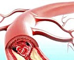 Вазоренальная артериальная гипертензия код мкб thumbnail