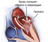 Код по мкб аномалии развития сердца thumbnail