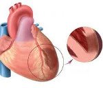 Острый трансмуральный инфаркт передней стенки миокарда код по мкб 10 thumbnail
