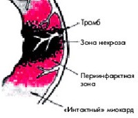 Острый трансмуральный инфаркт нижней стенки миокарда мкб 10 thumbnail
