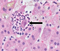 Цитомегаловирусный гепатит код по мкб thumbnail