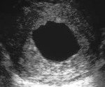 Анэмбриония код мкб 10 thumbnail
