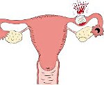 Нарушенная трубная беременность код мкб thumbnail