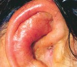 Абсцесс ушной раковины код мкб thumbnail