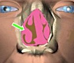Гипертрофия носовой раковины код мкб thumbnail