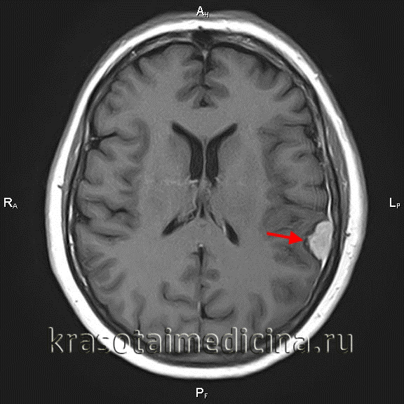 Последствия операций на головном мозге код мкб thumbnail