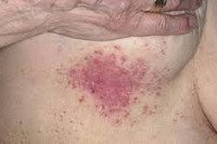 Кандидозный дерматит код мкб 10 thumbnail