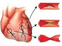 Стенокардия ишемическая болезнь сердца код по мкб 10 thumbnail