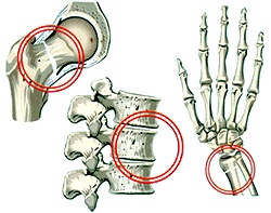Диффузный остеопороз код по мкб thumbnail