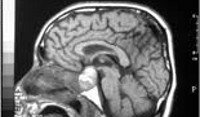 Аденома гипофиза головного мозга код мкб thumbnail