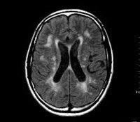 Энцефалопатия головного мозга мкб код thumbnail