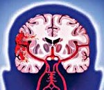 Геморрагический тип нарушения мозгового кровообращения код по мкб 10 thumbnail