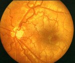 Код мкб гипоплазия диска зрительного нерва thumbnail