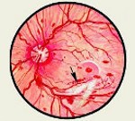 Диабетическая ретинопатия код мкб thumbnail