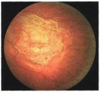 Центральная хориоретинальная дистрофия сетчатки глаза мкб 10 thumbnail