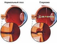 Вторичная глаукома код мкб thumbnail