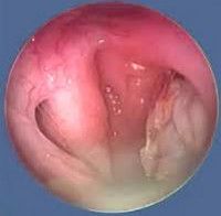 H68 Воспаление и закупорка слуховой [евстахиевой] трубы