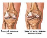 Артроз коленного сустава лечение мкб thumbnail