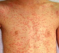 Лекарственная аллергия шифр по мкб 10 thumbnail