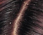 Себорея волосистой части головы код мкб thumbnail