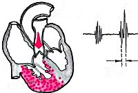 Код мкб хроническое легочное сердце thumbnail