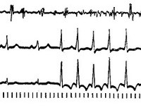 Код мкб 10 нарушение ритма сердца пароксизмальная тахикардия thumbnail