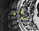 Миелопатия спинного мозга код по мкб 10 thumbnail