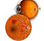 H35.0 Фоновая ретинопатия и ретинальные сосудистые изменения