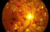 H35.0 Фоновая ретинопатия и ретинальные сосудистые изменения