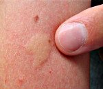 Аллергический отек на укус насекомого по мкб thumbnail