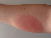 Аллергическая реакция на укус насекомого код по мкб 10 у детей thumbnail
