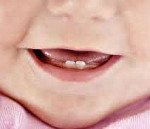 Мкб код синдром прорезывания зубов у детей thumbnail