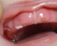 K00.7 Синдром прорезывания зубов