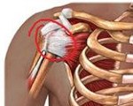 Импиджмент синдром плечевого сустава мкб 10 код thumbnail