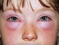 Аллергия на животных код мкб thumbnail
