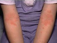 Код мкб аллергический дерматит у детей thumbnail