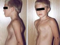 Воронкообразная деформация грудной клетки у детей код мкб thumbnail