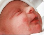 Токсическая эритема новорожденных код по мкб thumbnail