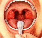 Стандарт лечения герпетической ангины thumbnail