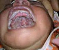 Молочница у новорожденных во рту код мкб thumbnail