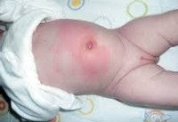P38 Омфалит новорожденного с небольшим кровотечением или без него