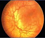 Мкб код ретинопатия недоношенных thumbnail