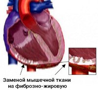 Код мкб трансплантация сердца thumbnail