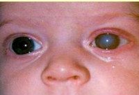 Врожденная глаукома код мкб thumbnail