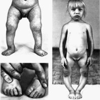 Хондродисплазия у детей врожденная код по мкб 10 thumbnail