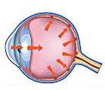 Открытоугольная ювенильная глаукома