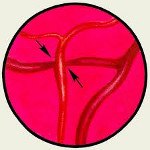Тромбоз центральной артерии сетчатки мкб thumbnail