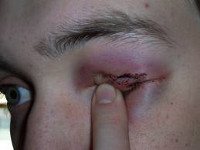 Травма глаз и глазницы. Ушиб глазного яблока и тканей глазницы III-IV степени thumbnail